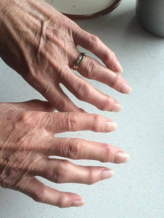 Giver din gigt dig smertefulde led og hændert? Få gratis hjælp og tips til bedre livskvalitet - Seniorpleje